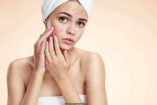 Tìm cách chăm sóc da mặt sau khi nặn mụn tốt nhất